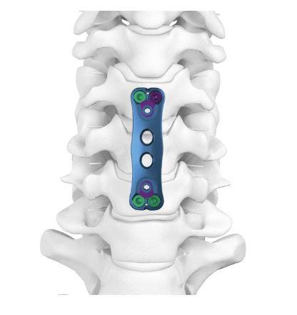 Пластина для педнє-шийного відділу І, ( Double Medical Technology Inc.)